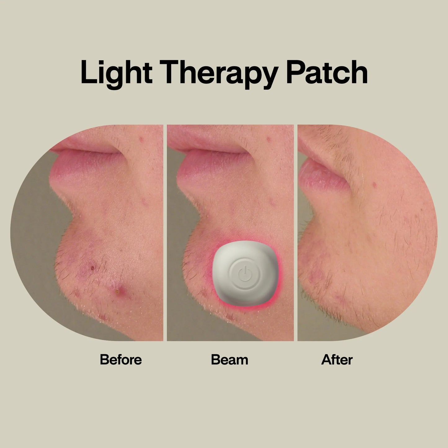 LED Light Therapy Acne Patches