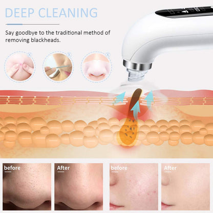 ClearSkin™ Pore Vacuum Blackhead Remover